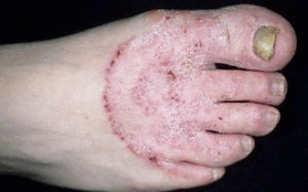 Οι λόγοι για την εμφάνιση του μανιταριού στα πόδια