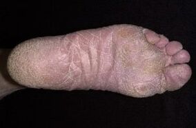 Σημεία και συμπτώματα μανιταριών στα πόδια