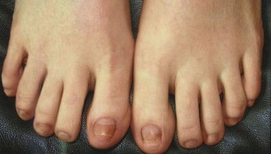 Φάσεις ανάπτυξης του μύκητα νυχιών