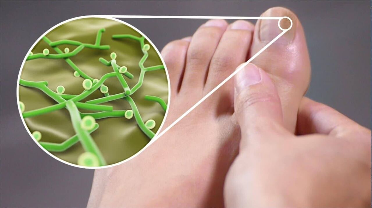 Παθογόνο μύκητα των νυχιών