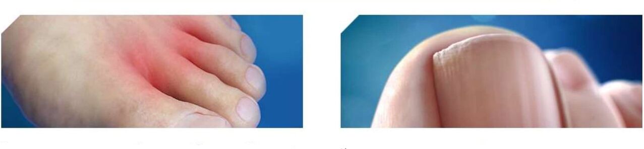 Αρχικό στάδιο του ποδιού του αθλητή